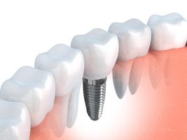 بهداشت دهان و دندان ،دندان سفید دندان پزشکی 2