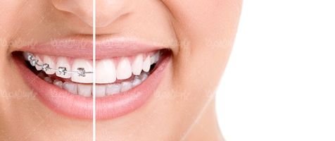 داندان پزشکی ارتودنسی دندان های منظم