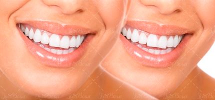 جرم گیری دندان ،دندان پزشک2 