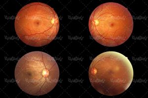 retina