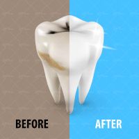 وکتور دندان پزشکی پلاک های دندان دندان کثیف دندان تمیز جرم گیری دندان1