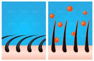 وکتور مراقبت از مو وکتور کاشت مو وکتور پیوند مو
