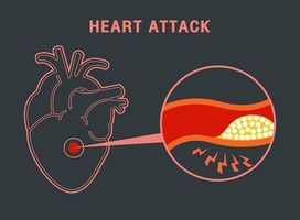 وکتور پزشکی وکتور گرفتگی رگهای قلب