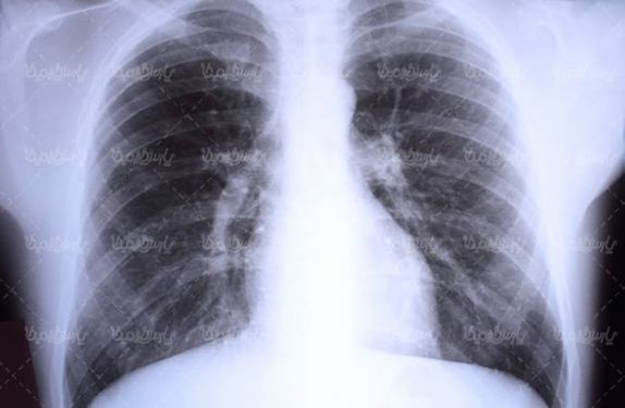 آناتومی بدن انسان شش ریه تنفسی عوارض دود سیگار5