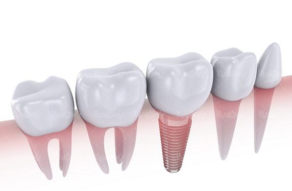 دندان ایمپلنت کاشت دندان دندان پزشکی