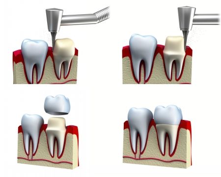 دندانپزشکی عصب کشی ترمیم دندان 1