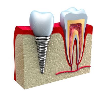 ایمپلنت داندانپزشکی دندان