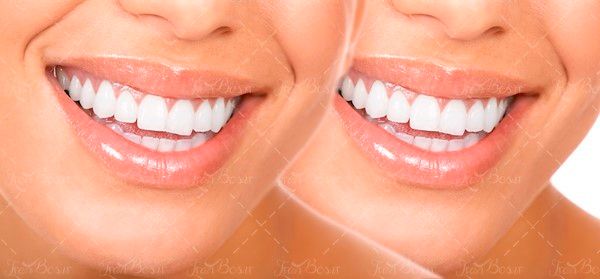 جرم گیری دندان ،دندان پزشک2 