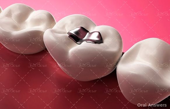 پر کردن دندان عصب کشی دندان 