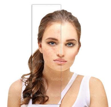 کلینیک زیبایی رفع جوش های صورت
