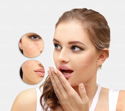 کلینیک زیبایی رفع جوش های صورت
