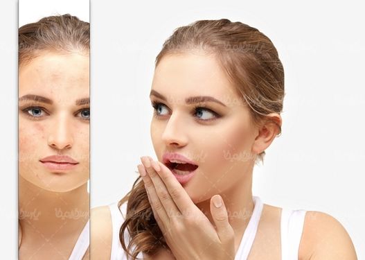 کلینیک زیبایی رفع جوش های صورت