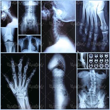 عکس گرافی بدن بیمار