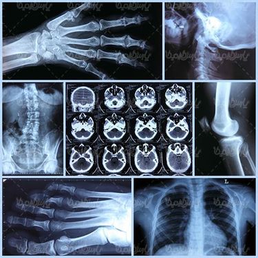 عکس گرافی بدن بیمار
