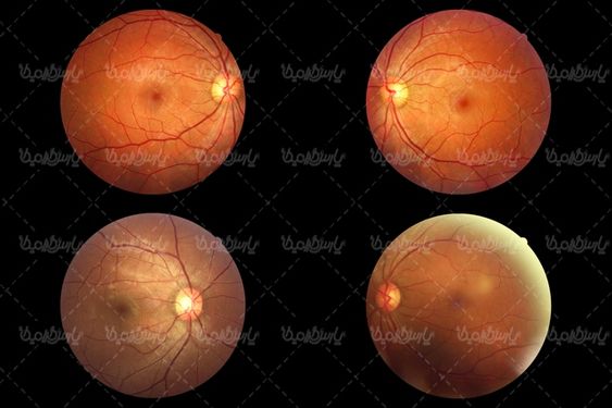 retina