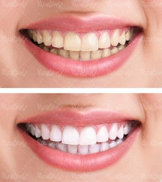 دندان های سفید
