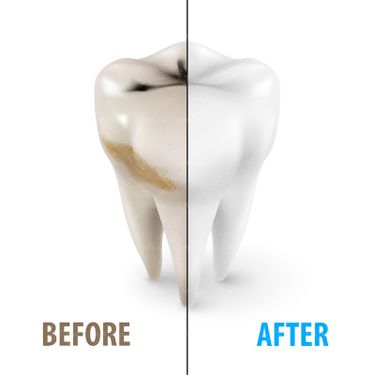 وکتور دندان پزشکی پلاک های دندان دندان کثیف دندان تمیز جرم گیری دندان