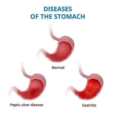 وکتور پزشکی وکتور معده