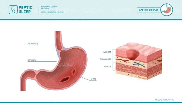 Stomach vector